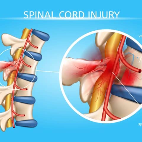 Abogados En Lesiones De La Médula Espinal De Barstow
