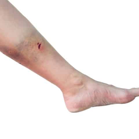 Lesiones Por Mordeduras De Perros En Victorville