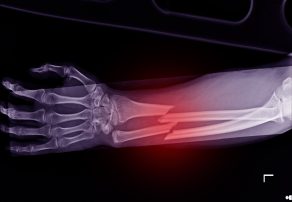 Abogados Especializados En Lesiones De Huesos Rotos De Merced