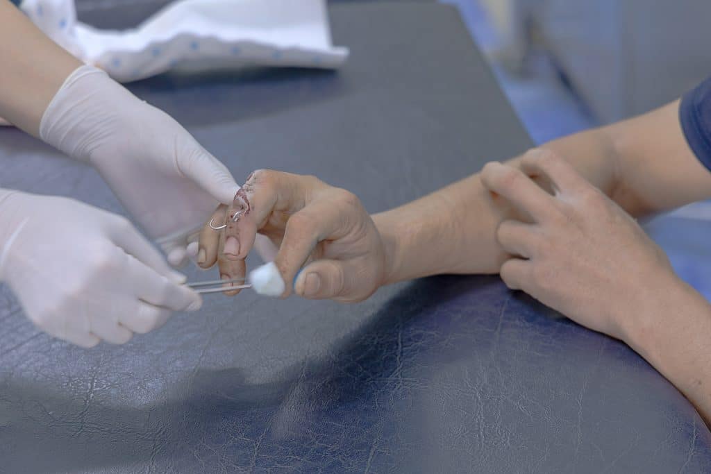 Cierre en primer plano de la fijación interna de fracturas de dedos, clavo intramedular.