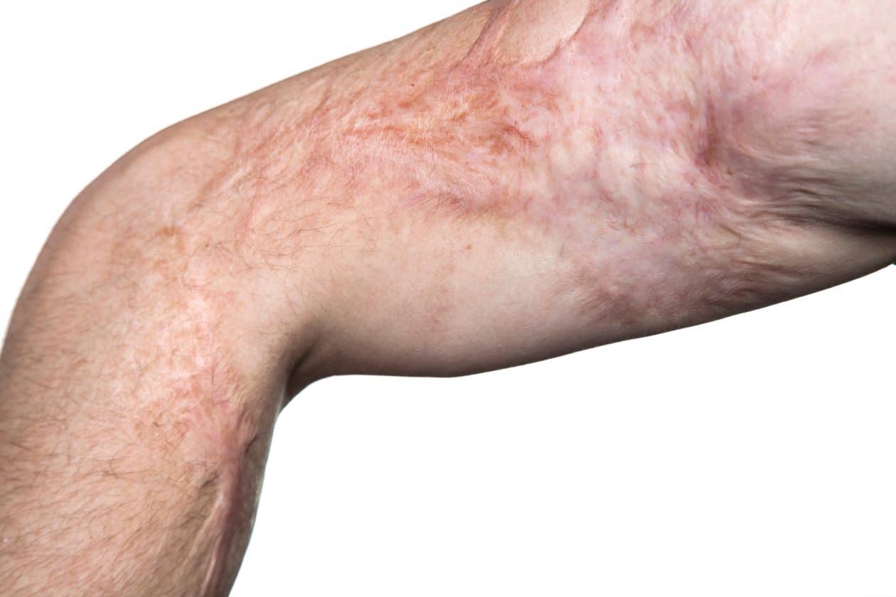 Brazo con cicatrices visibles y decoloración en la piel, posiblemente resultado de una lesión, quemadura o condición médica. La imagen está enfocada en el área del codo y muestra detalles del tejido cicatrizado.